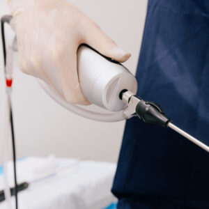 A close-up of a gloved hand performing tumescent liposuction near Granger, IN